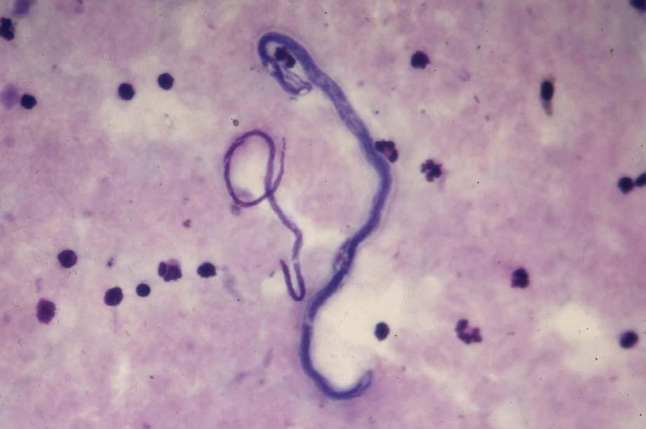 Mansonella perstans and Loa loa. Loa loa is distinctly longer and thicker than M. perstans. In the thick film the microfilaria of Loa loa show irregular coiling.