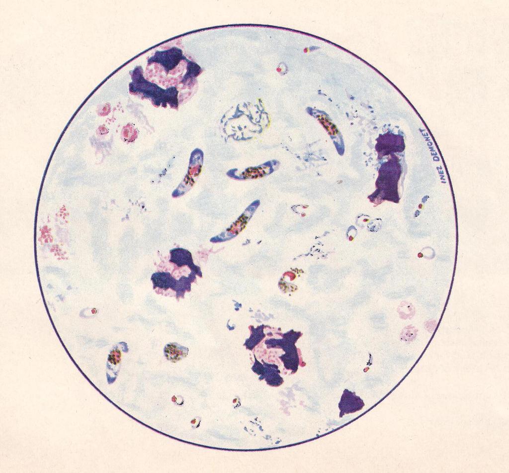 Plasmodium falciparum in thick film Courtesy U.S.