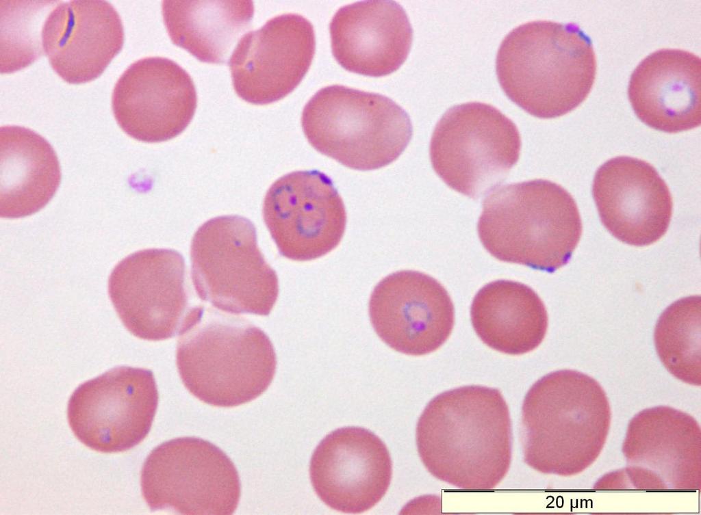 Plasmodium falciparum: three rings in one red blood cell, ring with two