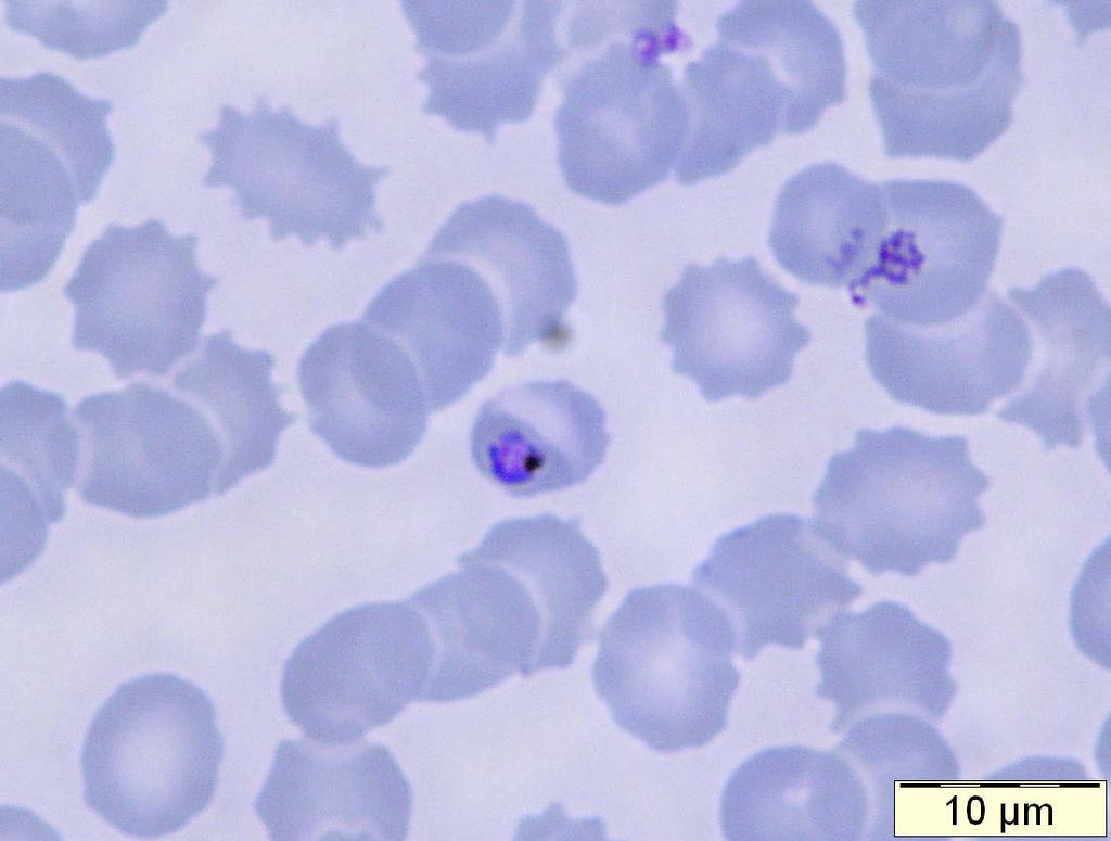 Plasmodium falciparum: with very dark pigment collected in one small,