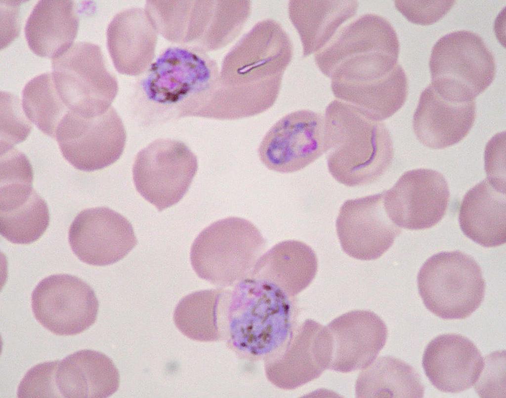 Plasmodium ovale: one gametocyte