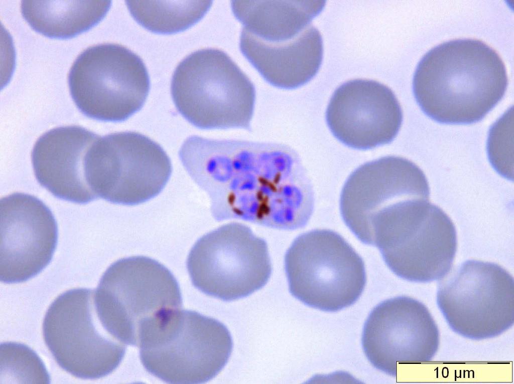 Plasmodium ovale: enlarged cell with schizont