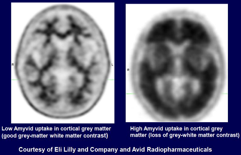 Florbetapir Amyloid PET Amyloid PET FDA Labeling to estimate β-amyloid neuritic plaque density in adult patients with cognitive impairment who are being evaluated for Alzheimer s disease (AD) and