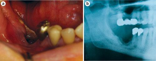 Figure 1 Gross and radiographic appearance of osteonecrosis of the jaw Reproduced with permission from Elsevier Ltd Abu-Id, M. H. et al. J. Craniomaxillofac.