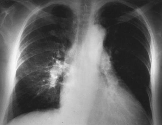 SSc and the Lungs