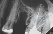 weeks. It is also recommended for third molar extraction sockets to ensure good bony support on the distal of the second molar.