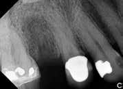 Case 3: Extraction of tooth #8 due to severe periodontal defect in a