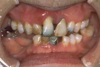 a single tooth implant that was placed after extraction due to