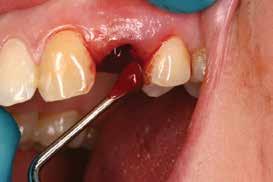 Case 4: Tooth extraction of #13 due to subosseous fracture of