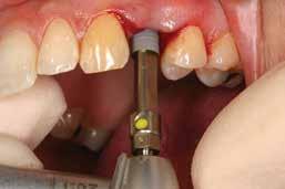 extraction of tooth #12 was necessary due to the extensive