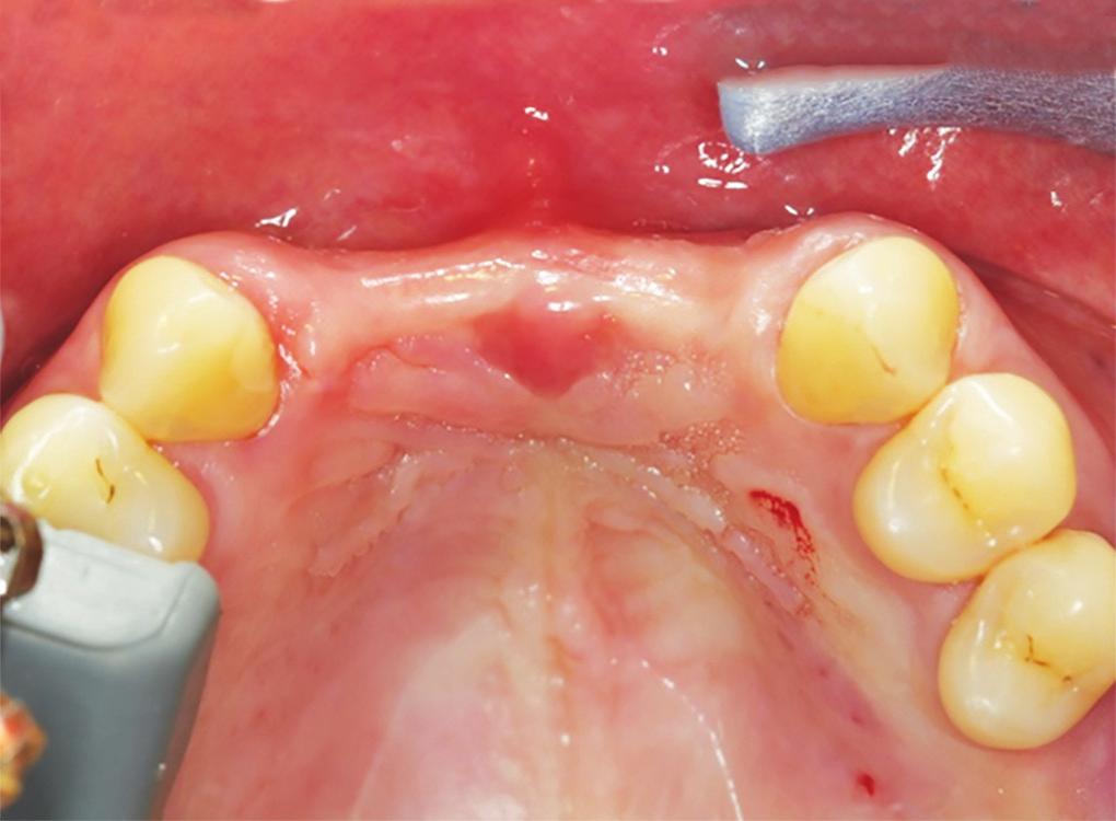 JCDP Alveolar Ridge Augmentation using the Allograft Bone Shell Technique Other methods of alveolar ridge augmentation include the use of autogenous bone derived directly from the patient, either