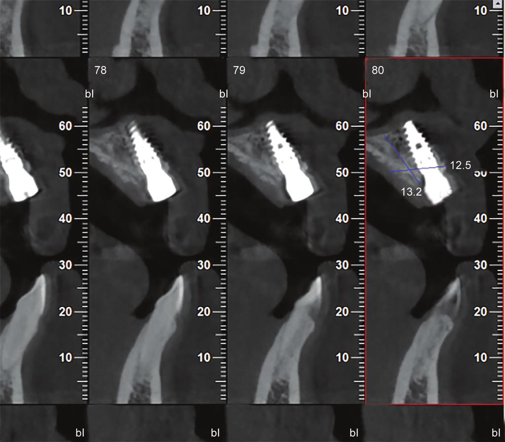In order to overcome this, Khoury, 7 introduced a new technique that involved using bone harvested from the patient s mandible, and placing this bone in a shell type structure over the defect to