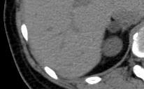 AVS Case 3: Results of Bilateral Adrenal Venous Sampling