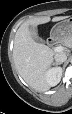 AVS Case 4: 39-yr-old woman with poorly