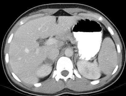 unilateral adrenal