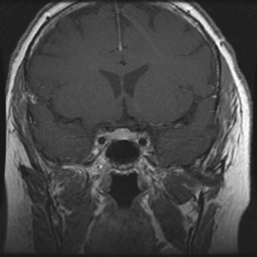 Pituitary MRI shows a