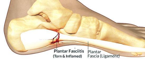 Plantar Fasciitis Most common cause of heel pain Inflammation of the plantar fascia Plantar Fascia Ligament that connects your heal bone to