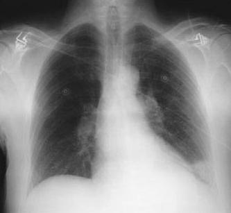 Pulmonary Embolism Diagnosis initial initial tests CXR Usually non Usually non-specific or normal ECG Sinus tachycardia, non-specific changes ABG PaO 2 D-DimersDimers PaCO 2 Strong neg.