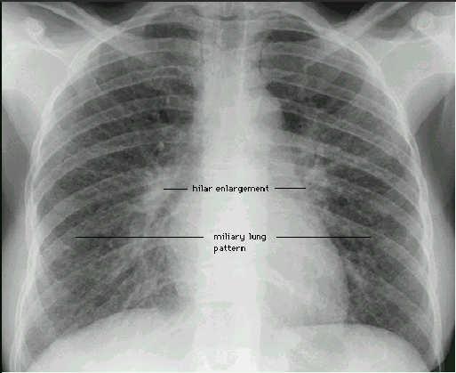 Interstitial Lung Disease Categories Idiopathic fibrotic Connective tissue disease Primary Drug induced Occupational/environmental Interstitial Lung Disease Symptoms Dry cough, insidious dyspnea