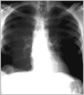 PE with effusion and elevated diaphragm
