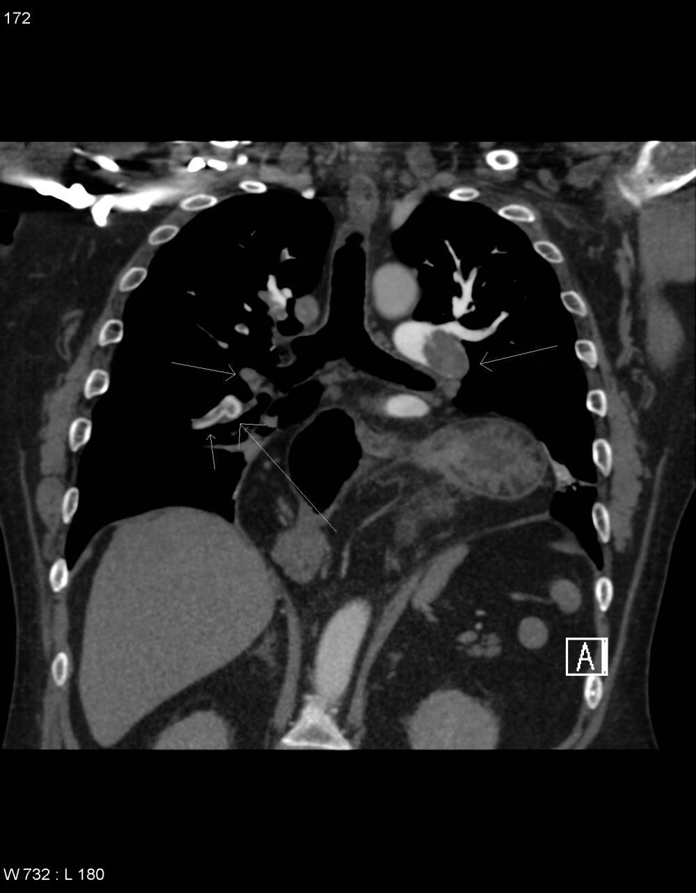 MDCT Findings D C A B Large saddle thrombus with extensive clot burden.
