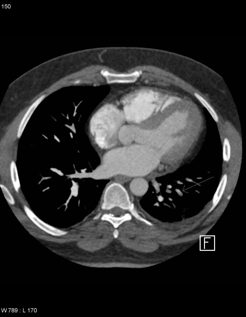 Left lower lobe subsegmental embolism (arrow) with associated atelectasis using high-pitch technique New Imaging Approaches Low dose