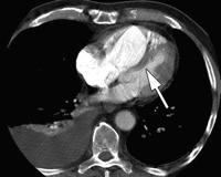 Transverse contrast material enhanced chest CT scan shows that ventricular septum bows leftward (arrow) into the