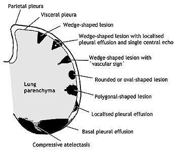 Schematic representation of the parenchymal, pleural and vascular features associated