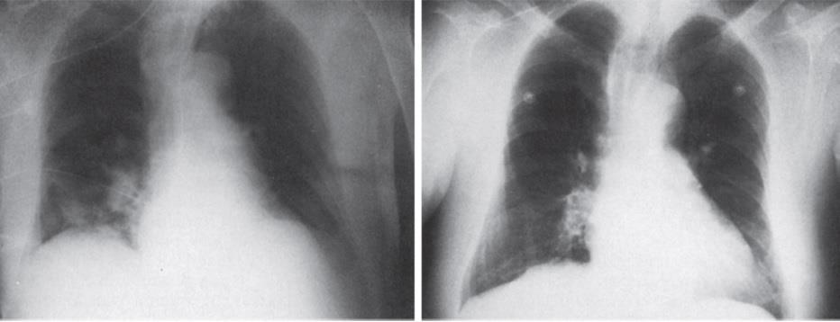 Figure 57-3 Chest radiographs in a patient with pulmonary embolism.