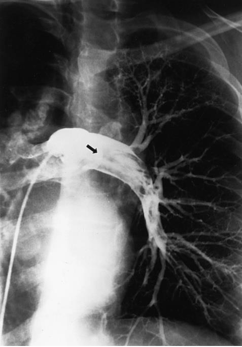 Figure 57-7 Pulmonary angiography for pulmonary embolism.