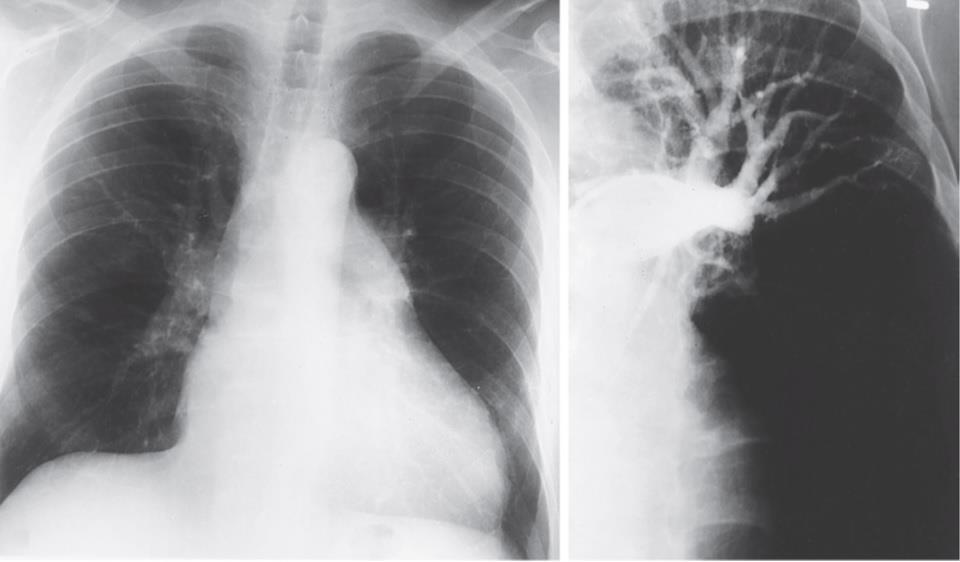 Figure 57-10 Chest radiograph in a patient with chronic thromboembolic pulmonary hypertension.