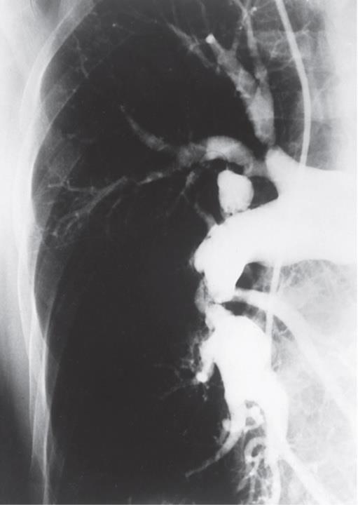 Figure 57-11 Rightsided pulmonary angiogram in a