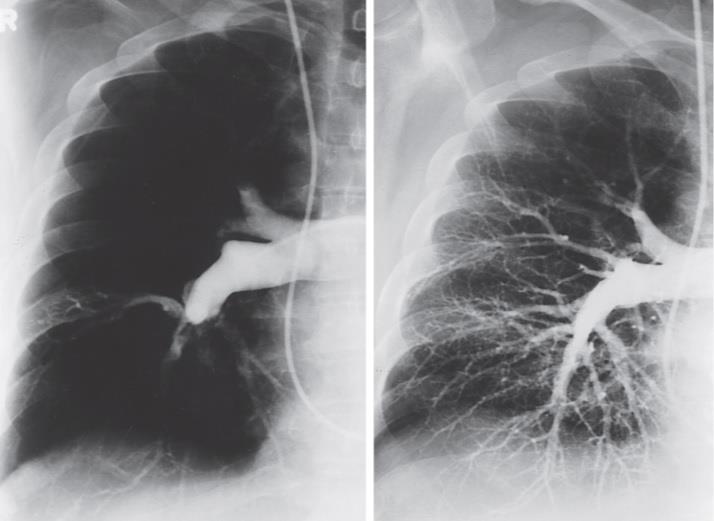 Figure 57-15 Pulmonary angiography before and after thromboendarterectomy.