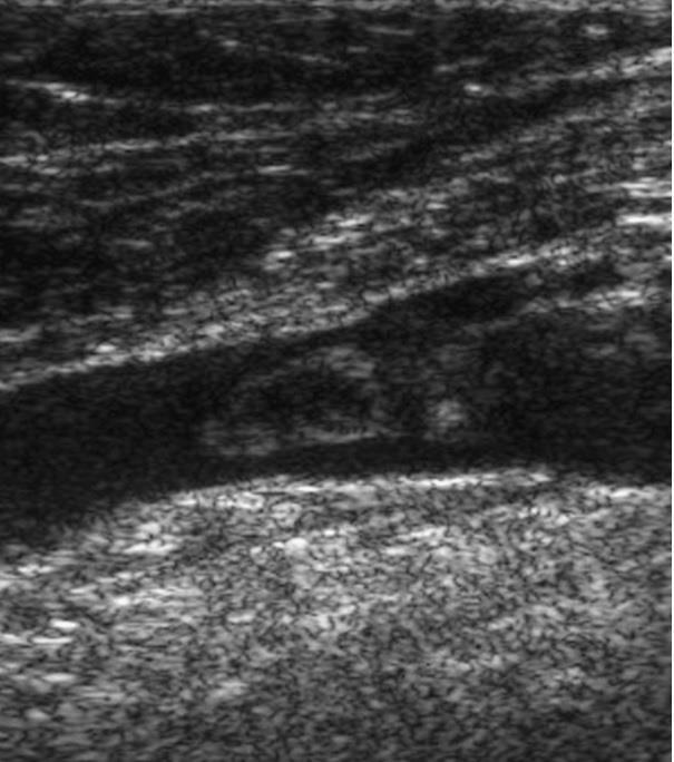 efigure 57-1 Ultrasound image of DVT.