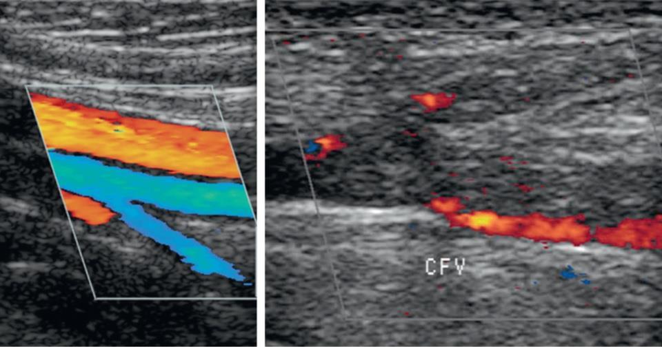 efigure 57-2 Color Doppler ultrasound of the lower extremity. A, Normal color Doppler examination of the lower extremity venous and arterial systems.