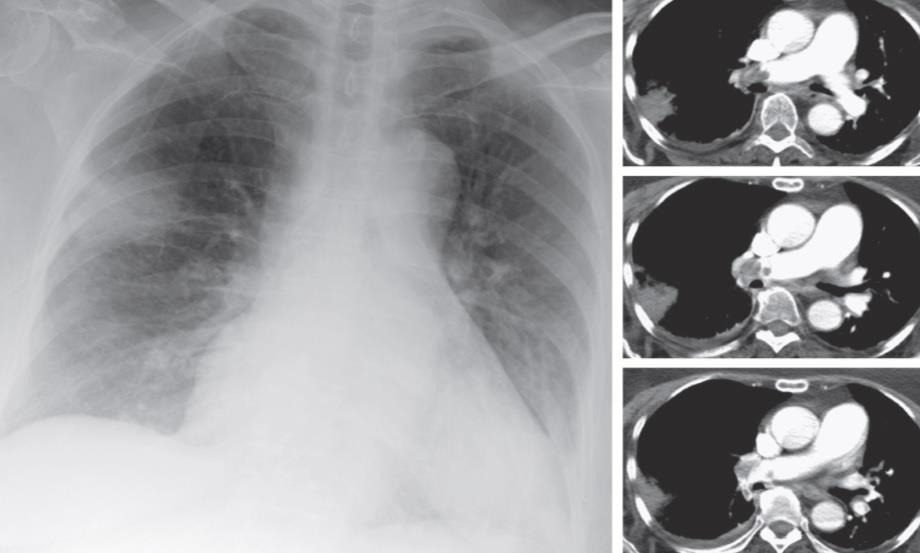 efigure 57-6 Acute pulmonary embolism.