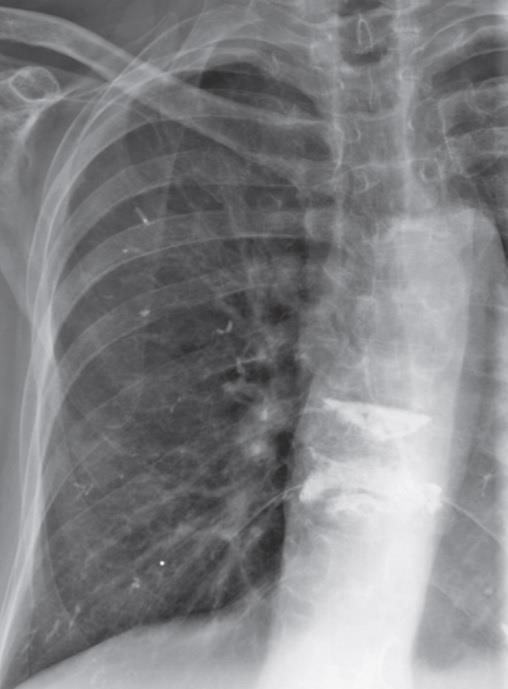 efigure 57-15 Methyl methacrylate pulmonary emboli following vertebroplasty.
