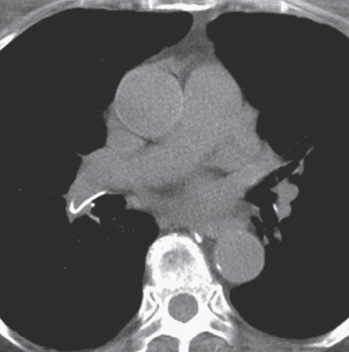 C, Axial unenhanced chest CT confirms high attenuation in the right interlobar pulmonary artery (arrows),