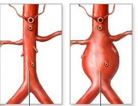 Blood Vessel Aneurysms An aneurysm is a localized, blood-filled dilation (bulge) of a