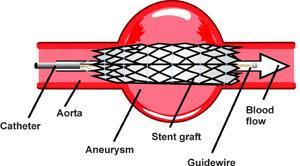 Blood Vessel Aneurysms A saccular aneurysm develops when fibers in the outer blood vessel layer separate allowing the pressure of the blood to force the two inner layers to balloon through.