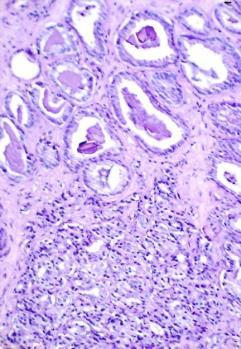 Prostate Histology 98% Adenocarcinoma Code acinar as adenoca 2% Other Neuroendocrine carcinoma Small cell carcinoma Lymphoma Sarcoma PIN III Do NOT abstract 30% men develop invasive CA