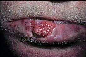 Biopsy of Lip Cutaneous lip biopsies would be better coded 11100.