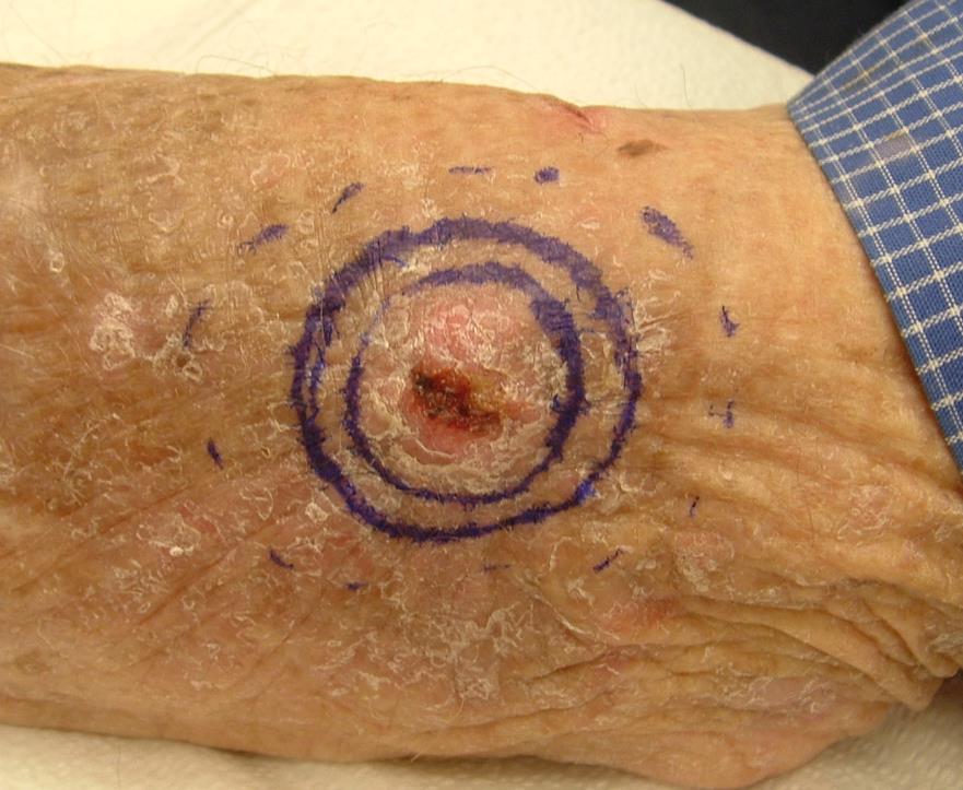 Is it an excision? Patient complains of rapidly growing tender lesion on left arm. Clinical diagnosis SCC (2.