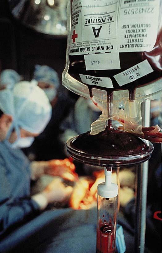Whole blood transfusions are used: When blood loss is substantial In treating thrombocytopenia