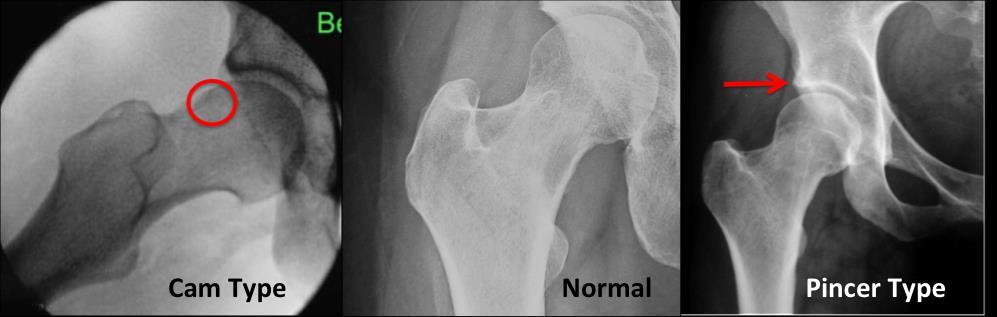 INTRODUCTION Osteoarthritis in the hip has been known to develop in older populations, resulting in open surgeries to repair damaged bone and cartilage and in many cases a total hip replacement is
