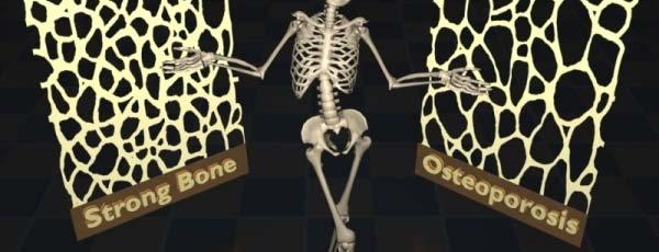 The Aging Bones & Joints Weight bearing and movable joints at highest risk for age-related degenerative changes Osteoporosis Risk factor increases over age 40 Higher fracture risk: Spine, Hip, Wrists