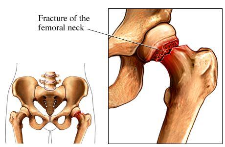 Your Surgery You have had surgery that involves replacing the ball part of your femur with an artificial one (prosthesis).