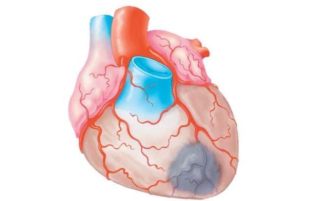 HERT TTCKS The damage or death of heart muscle tissue therosclerosis plaque