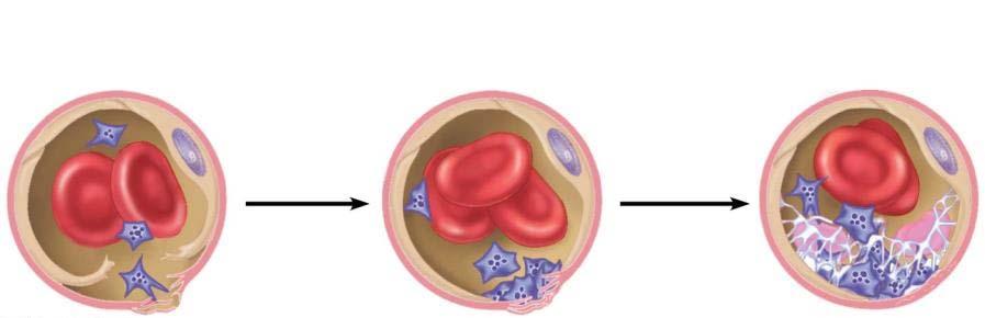 Constrict blood flow Platelets stick to broken epithelium cells and secrete sticky chemicals Fibrinogen is converted to fibrin and scab forms Platelets contract, decreasing size of broken