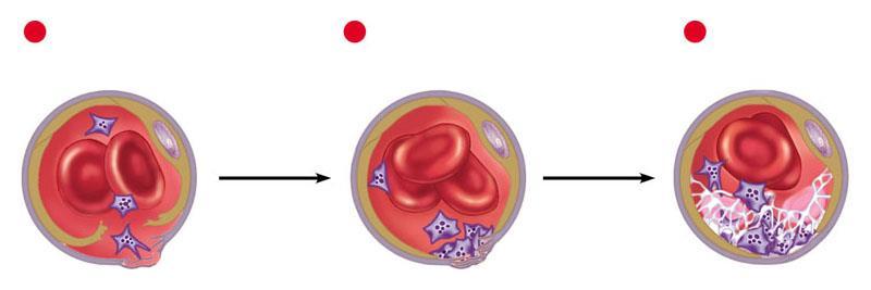The blood-clotting process 1 Platelets adhere to exposed connective tissue Epithelium 2 Platelet